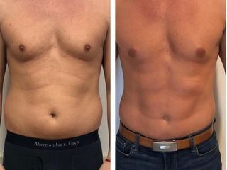 liposcultura prima dopo
