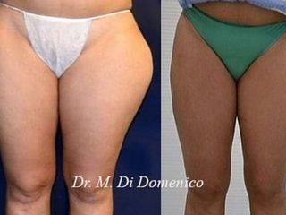 Liposuzione trocanteri e ginocchia prima dopo