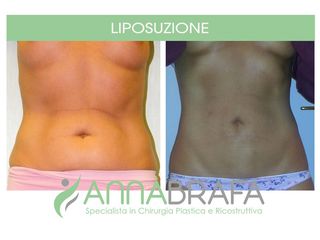 Liposuzione prima e dopo
