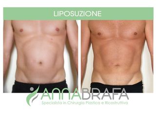 Liposuzione prima e dopo