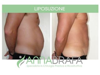 Liposuzione prima e dopo