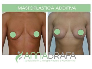 Mastoplastica additiva prima e dopo