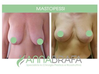 Mastopessi prima e dopo