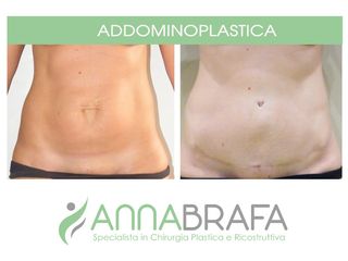 Addominoplastica prima e dopo