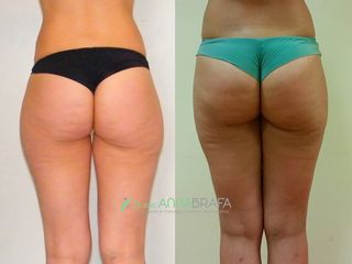 Liposuzione prima e dopo