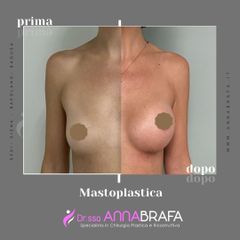 Mastoplastica additiva - Dott.ssa Anna Brafa