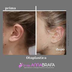 Otoplastica - Dott.ssa Anna Brafa