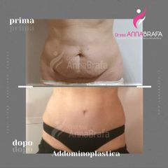 addominoplastica - Dott.ssa Anna Brafa
