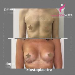 Mastoplastica additiva - Dott.ssa Anna Brafa