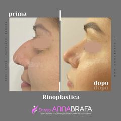 Rinoplastica - Dott.ssa Anna Brafa