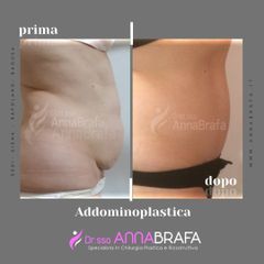 addominoplastica - Dott.ssa Anna Brafa