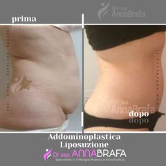 addominoplastica - Dott.ssa Anna Brafa