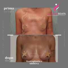 Mastoplastica additiva - Dott.ssa Anna Brafa