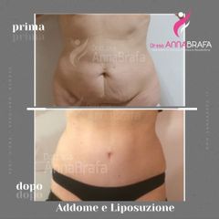 addominoplastica - Dott.ssa Anna Brafa