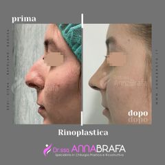 Rinoplastica - Dott.ssa Anna Brafa