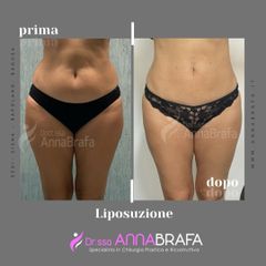 Liposuzione - Dott.ssa Anna Brafa
