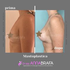 Mastoplastica additiva - Dott.ssa Anna Brafa