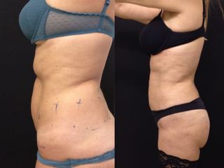 Liposcultura prima e dopo