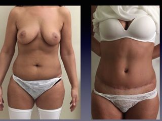 Liposcultura prima e dopo