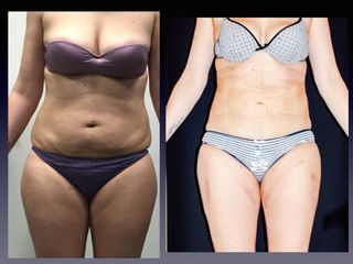 Liposcultura prima e dopo