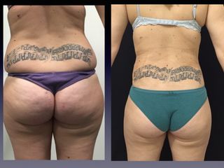 Liposcultura prima e dopo