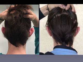 Trapianto capelli prima e dopo