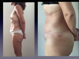 Liposcultura prima e dopo