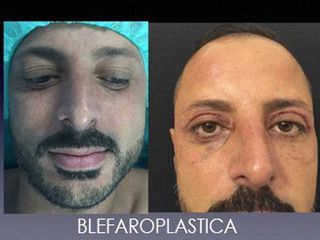 Blefaroplastica prima e dopo