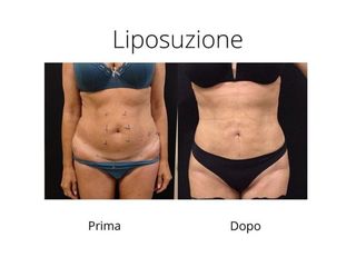 Liposuzione prima e dopo