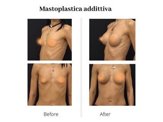 Mastoplastica additiva prima e dopo