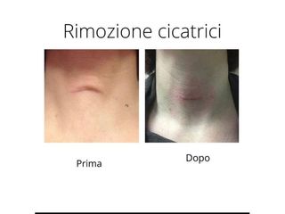 Rimozione cicatrici prima e dopo