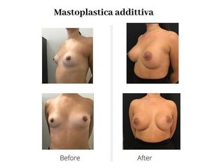 Mastoplastica additiva prima e dopo