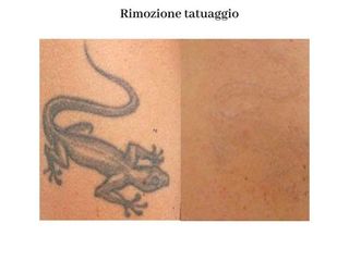 Rimozione tatuaggio prima dopo