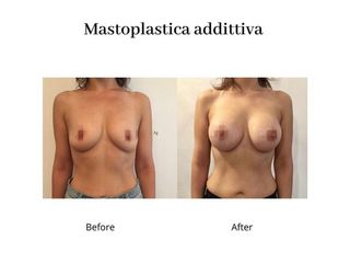 Mastoplastica additiva prima e dopo