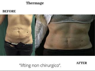 Thermage prima e dopo
