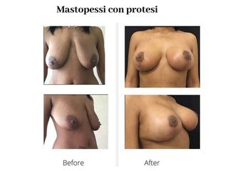 Mastopessi prima e dopo