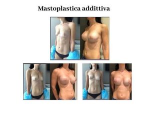 Mastoplastica additiva prima e dopo