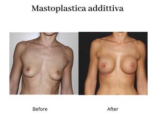 Mastoplastica additiva prima e dopo