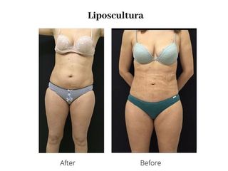 Liposcultura prima e dopo