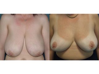 Mastoplastica riduttiva - Prof. Angela Faga