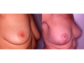 Mastoplastica additiva - Prof. Angela Faga