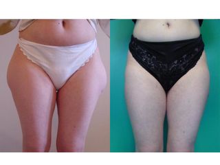 Liposuzione - Prof. Angela Faga
