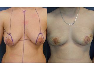 Mastopessi - Prof. Angela Faga