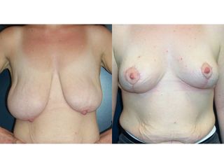 Mastopessi - Prof. Angela Faga