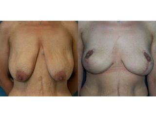 Mastopessi - Prof. Angela Faga