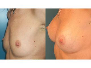 Mastoplastica additiva - Prof. Angela Faga