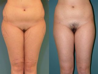Liposuzione - Prof. Angela Faga
