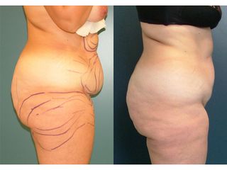 Liposuzione - Prof. Angela Faga