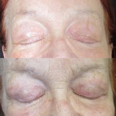 Blefaroplastica - Prof.ssa Angela Faga