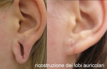 Prof.ssa Angela Faga ricostruzione dei lobi auricolari